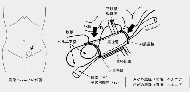 鼠径ヘルニア（脱腸）の見た目｜鼠径部の膨らみについて