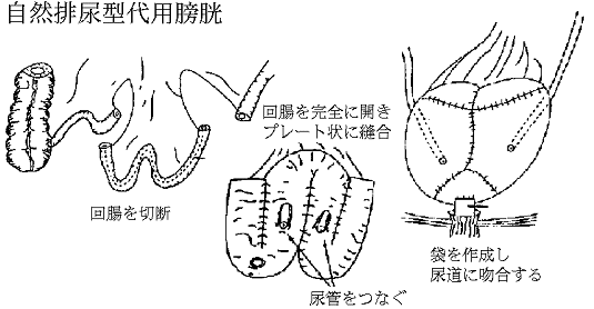 尿路再建術とは