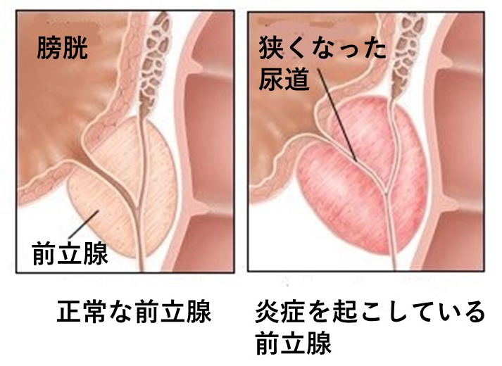 エネマグラを使って最高に気持ちいいお射精させてあげます -好意100％の小悪魔系後輩ちゃんに前立腺開発してもらう話- [アブソテリト]