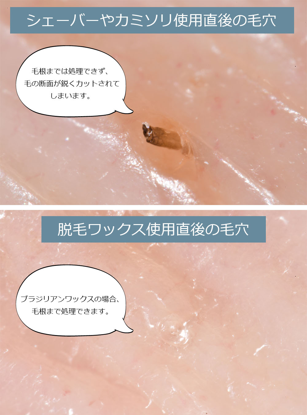 ブラジリアンワックスとビキニワックスの違い、効果持続期間や副作用について皮膚科医が解説｜ハーパーズ バザー（Harper's BAZAAR）公式