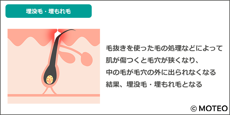 ヒゲ剃り・毛抜きの真実｜【ひげ脱毛】美容皮膚科メディエスクリニック