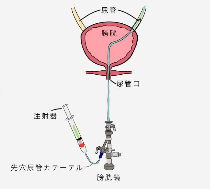 尿道狭窄症 | みんなの医療ガイド