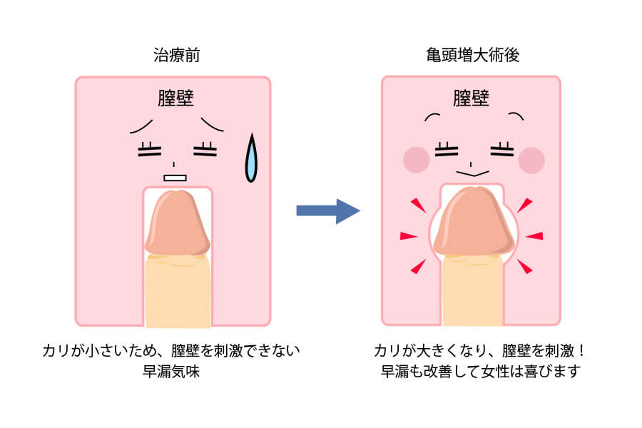 カリ高とはどんなペニス？カリ高の基準やメリットなどを紹介｜風じゃマガジン