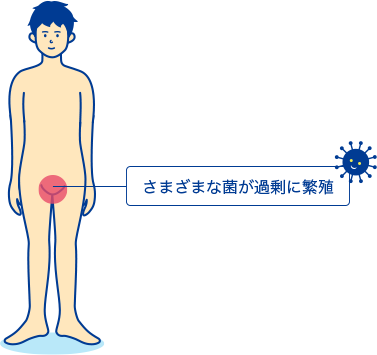 亀頭包皮炎は自然治癒する？|『治すための方法』と『病院に行くべきタイミング』を解説 | 泌尿器科｜GOETHE