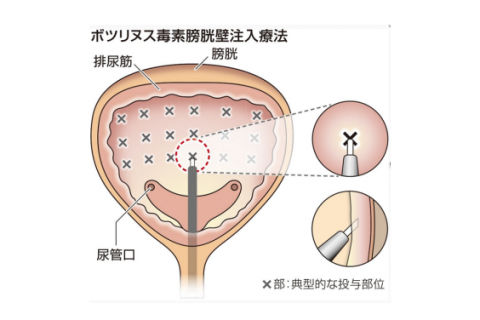 尿路結石とは？基本から再発予防まで痛くなる前に知っておくべきこと - 医療法人神楽岡泌尿器科