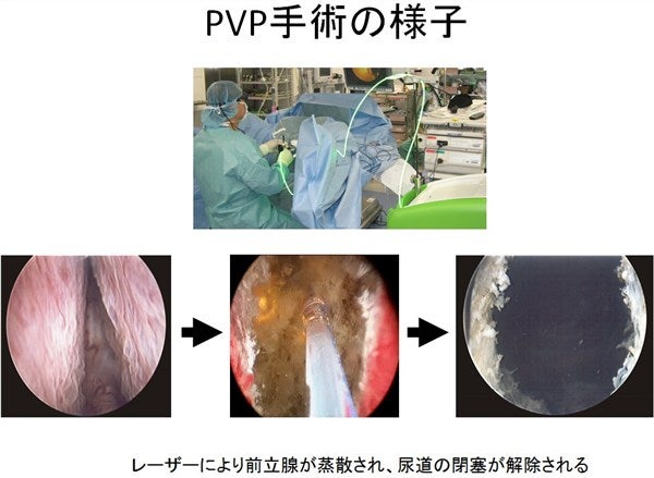 動画でわかる】「前立腺肥大症等」の病気・症状・治療方法の動画・医療情報 | Doctorbook