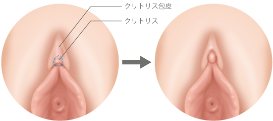 タンポンってどんなもの？（どこに入れるの？） | ソフィ ソフトタンポン-生理用品のソフィ-生理用品のソフィ