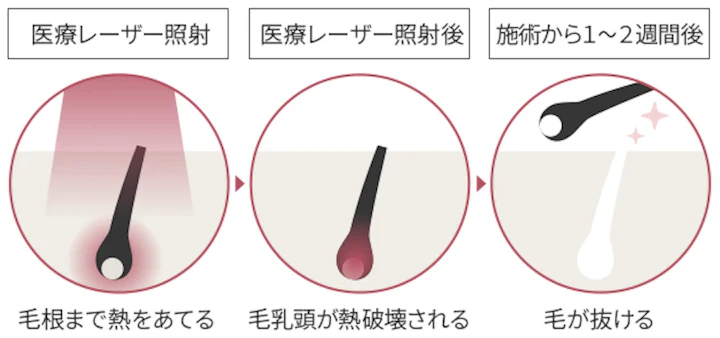 【抜毛】また生える毛と生えなくなった毛、何が起きてるんだろ😗？抜くデメリットも解説!