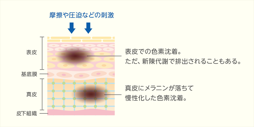 髭を長年抜いていたら、こうなりました。これは、髭で赤黒いのではなく、 - Yahoo!知恵袋