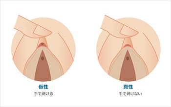 恥垢とは？溜まりやすくなる原因と治療法の解説 | コラム一覧｜