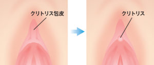 クリトリスを見つける方法は？ - テンシラバー