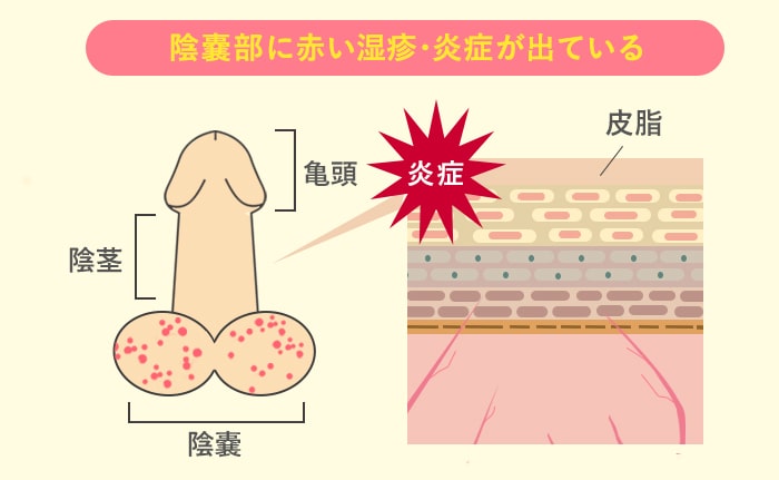 薬剤師が解説】陰嚢（いんのう）の湿疹におすすめの市販薬はどれ？9選を紹介 – EPARKくすりの窓口コラム｜ヘルスケア情報