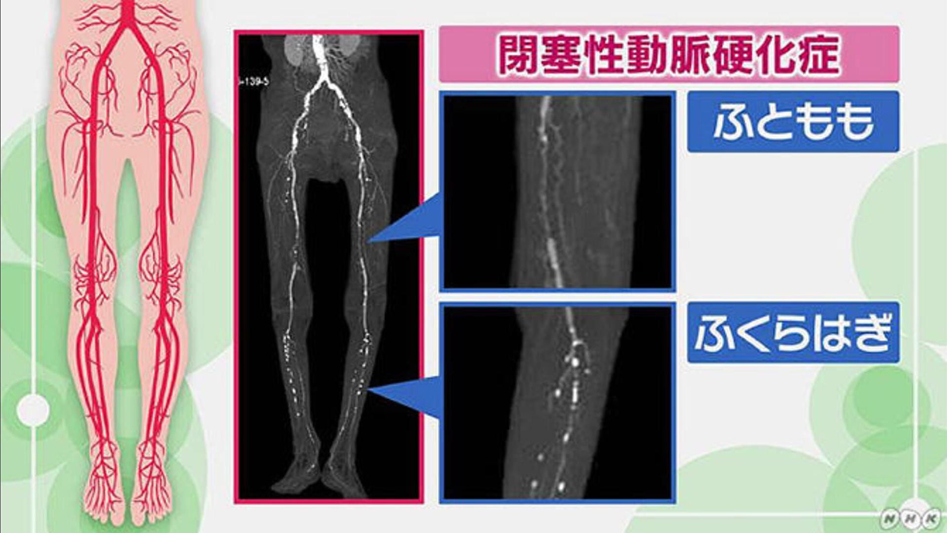 ふくらはぎが痛む | あなたの症状の原因と関連する病気をAIで無料チェック