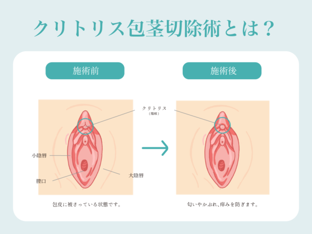 クリトリスの皮を剥くコツは？クリイキするための正しい剥き方をイラストでチェック