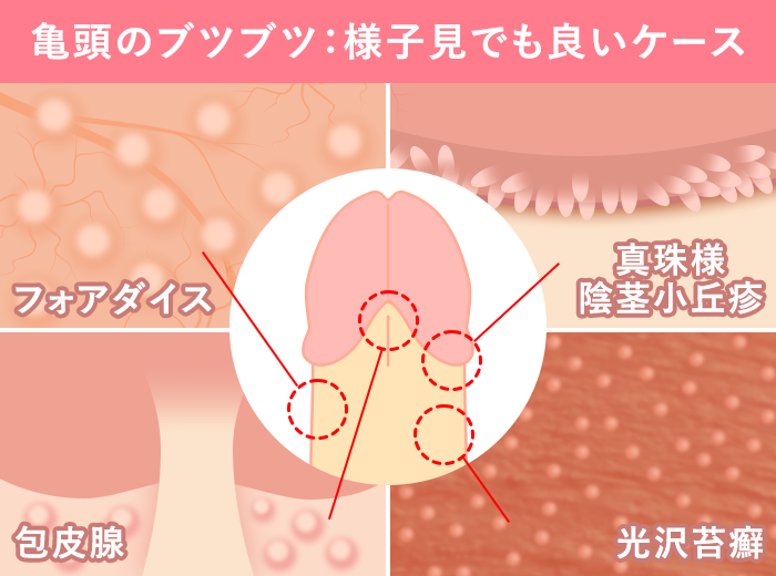 陰部のぶつぶつ、これって性病？ デキモノや症状から何の病気かを知る |