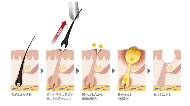 医師監修】毛を薄くする方法！中学生・高校生、男性の濃い毛を目立たなくするには | Midashinami