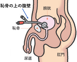 尿路結石の治療について | 医療法人社団實理会