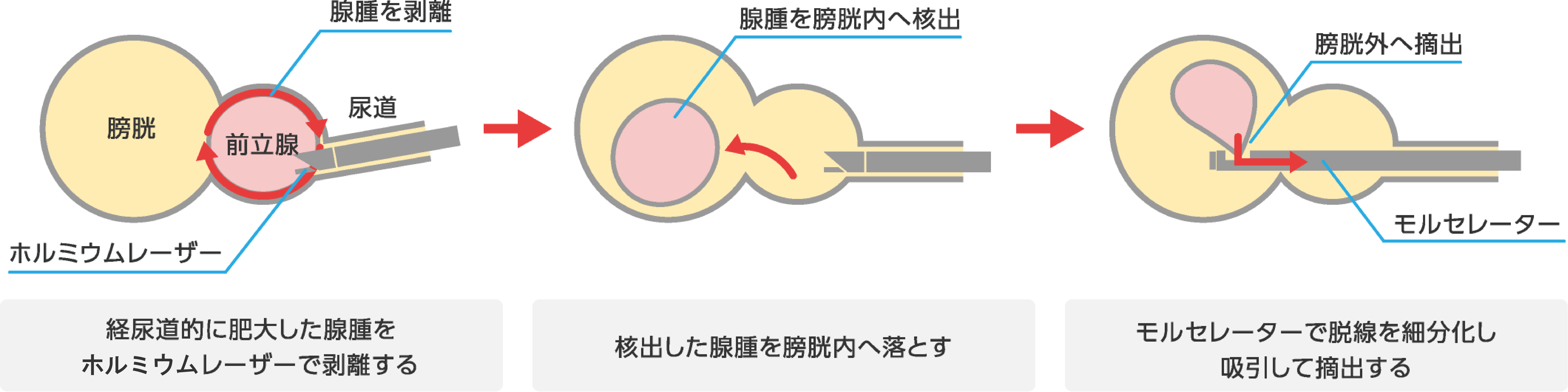 膀胱がんの治療について - 愛知医科大学泌尿器科