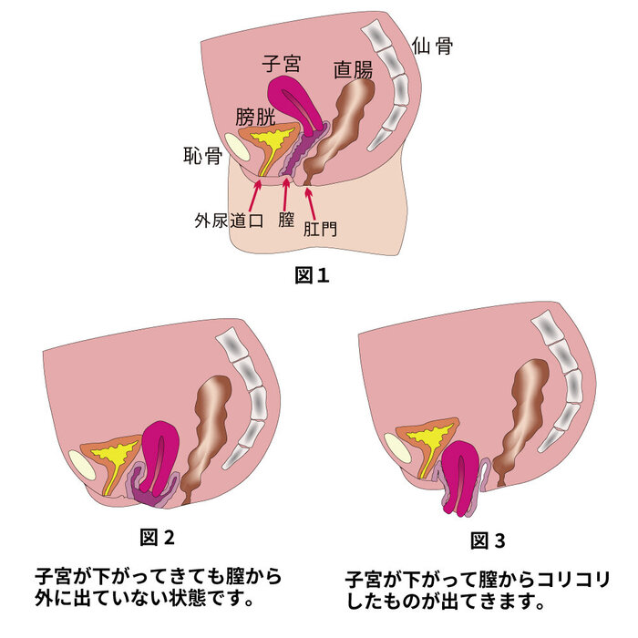 骨盤臓器脱 ―シニア女性の生活の質を下げる子宮脱、膀胱瘤、直腸瘤―｜京都済生会病院