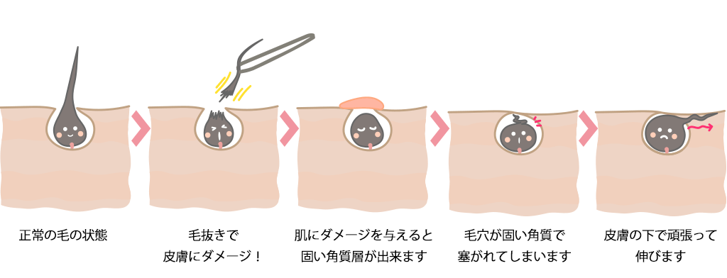 毛を抜く」自己処理はNG！脱毛中にムダ毛をなくす正しい処理方法 | メンズ脱毛百科事典