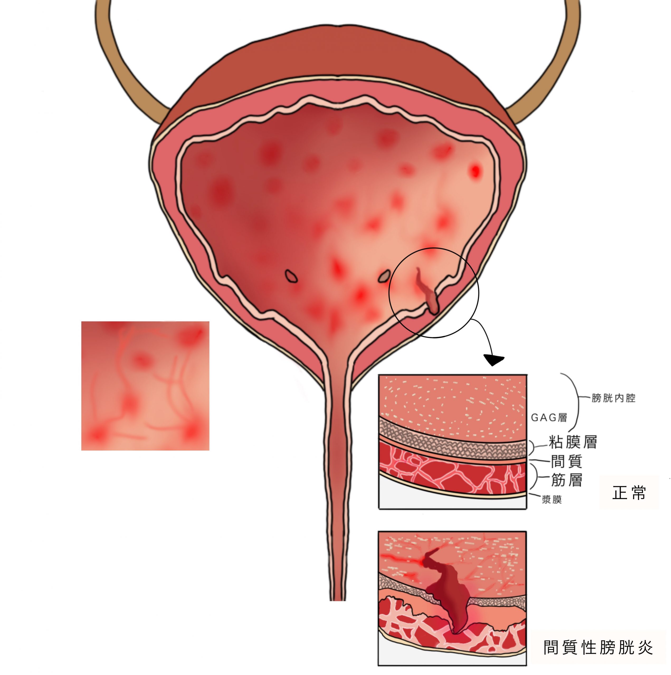 前立腺肥大症手術（HoLEP）の流れの説明｜桐友クリニック新松戸