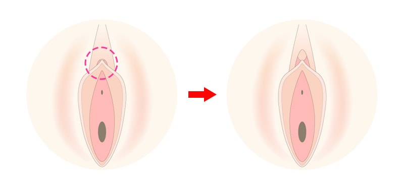 クリトリスの皮を剥くコツは？クリイキするための正しい剥き方をイラストでチェック