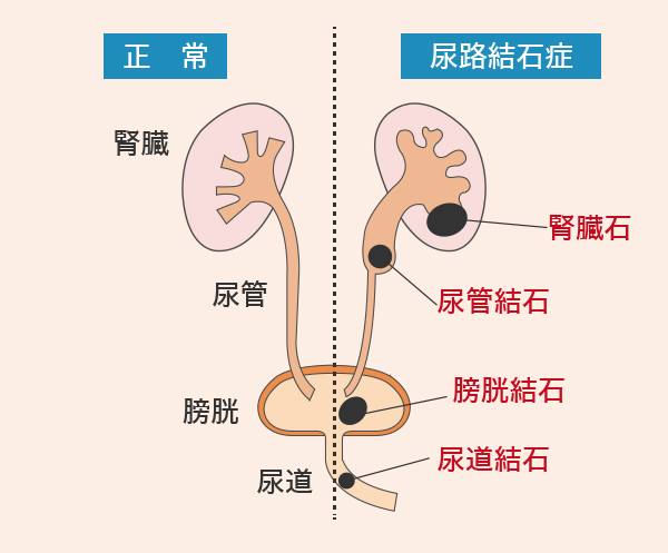 性行為（セックス）は尿路結石症の改善に役立つ可能性がある【医師監修】 | 新橋ファーストクリニック【公式】