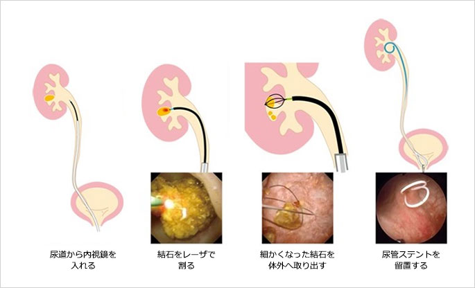 尿の色は病気のサイン 茶色・白・透明で注意するのは -