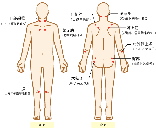 シンスプリント（脛骨過労性骨膜炎） | 慢性痛治療の専門医による痛みと身体のQ＆A