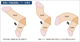 シリコンボールの効果・効果的な位置 – メンズ形成外科 | 青山セレス&船橋中央クリニック