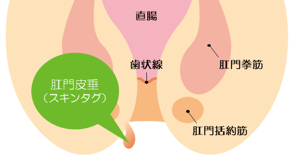 包茎とは・包茎の種類・包茎は病気なの？ – メンズ形成外科 |