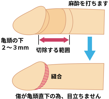 カントン型包茎の症状と手術方法｜包茎手術・治療なら新宿形成外科