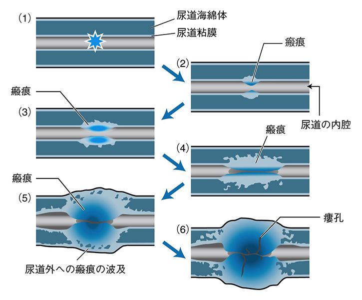 前立腺肥大症手術（HoLEP）の流れの説明｜桐友クリニック新松戸