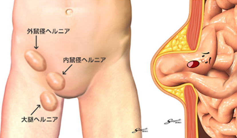 西宮市の鼠径ヘルニア・脱腸の患者さまに当院が選ばれる理由