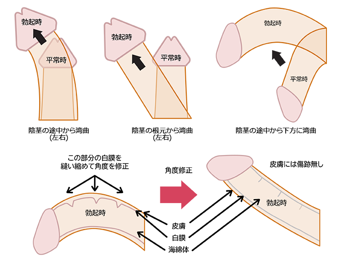 長茎 | セントラルクリニック（大阪難波・神戸元町・周南市徳山・滋賀草津・三重県津院） 男性専門美容形成外科