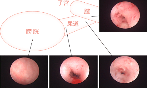 尿路結石は腎盂拡張の原因 | 看護roo![カンゴルー]