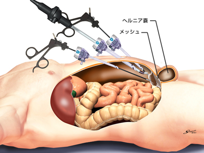 講義資料公開・報告】第31回 JNOS ウェビナー Dr.吉田の腰殿部痛④「鼠径部、大腿外側部」