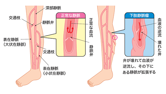 ふくらはぎがだるい｜下肢静脈瘤の日帰り手術