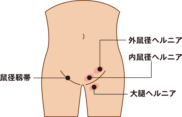 鼠径部痛症候群（グロインペイン症候群） ｜SPORTS MEDICINE LIBRARY｜ザムスト（ZAMST）