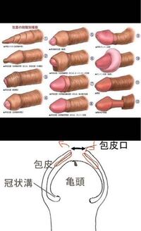 カントン包茎（嵌頓包茎）とは？手術と費用について｜MSクリニック