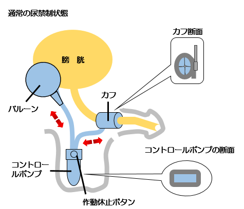 尿道狭窄症 (にょうどうきょうさくしょう)とは |