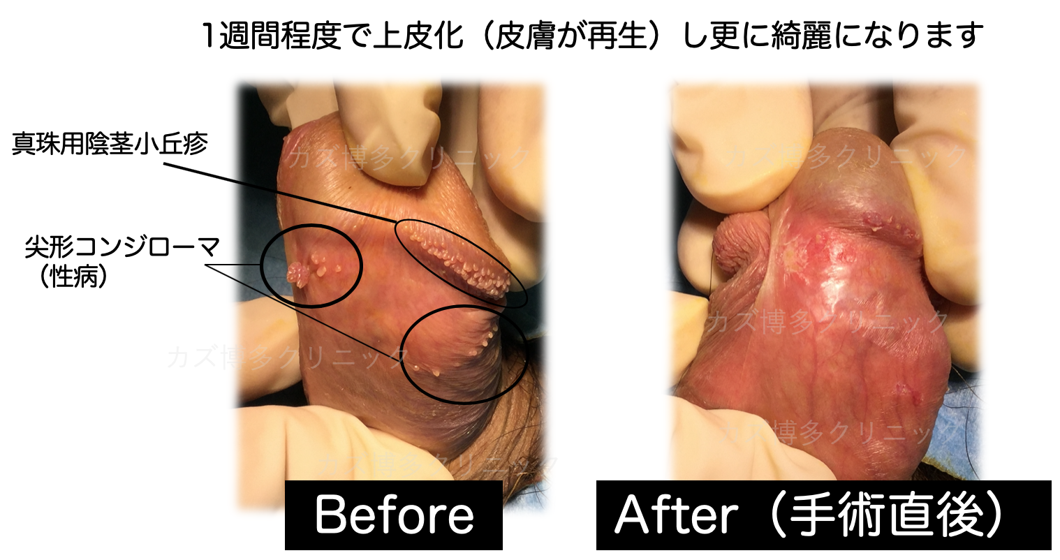 亀頭・陰茎のぶつぶつ（フォアダイス・真珠様陰茎小丘疹）｜札幌中央クリニック 美容外科・形成外科