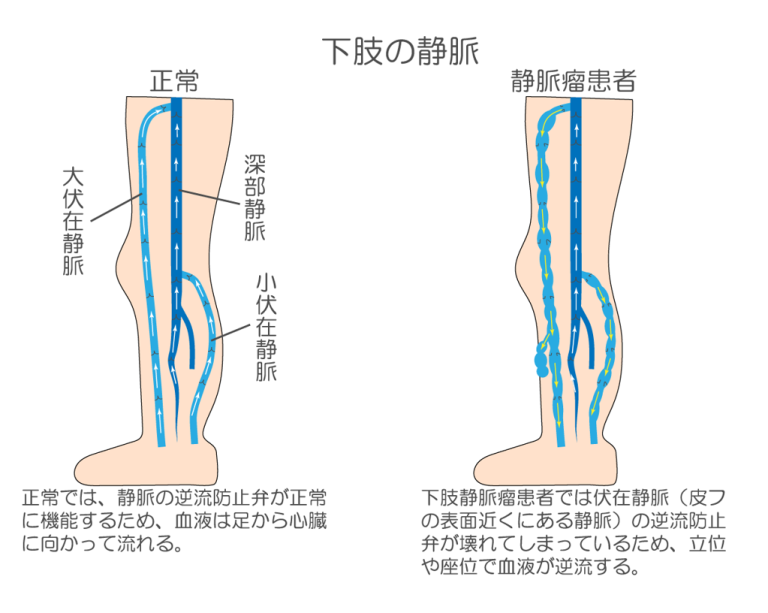 下肢静脈瘤は何科にいけばいい？下肢静脈瘤の専門医師が解説｜さかえ血管外科・循環器クリニック診療案内