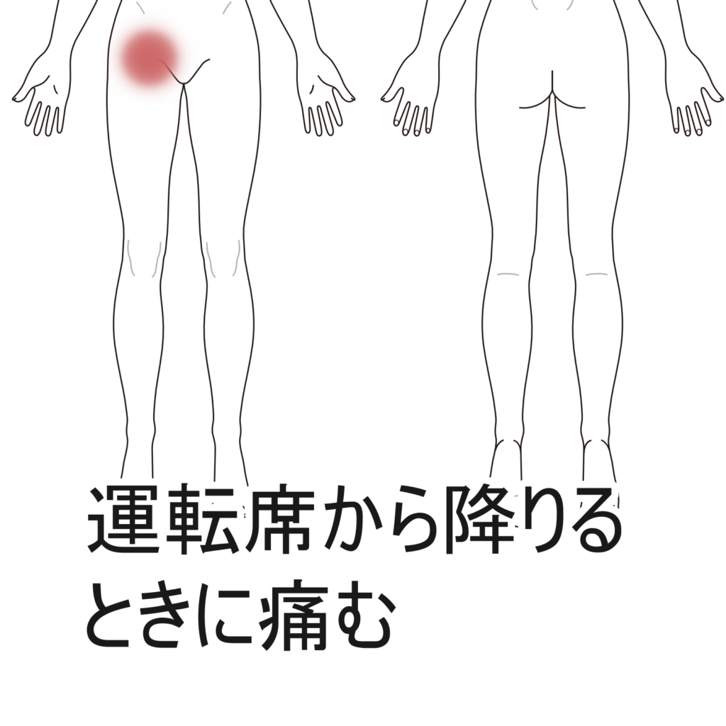 教えて！「鼠径（そけい）ヘルニア」 | 腹腔鏡ヘルニアセンター