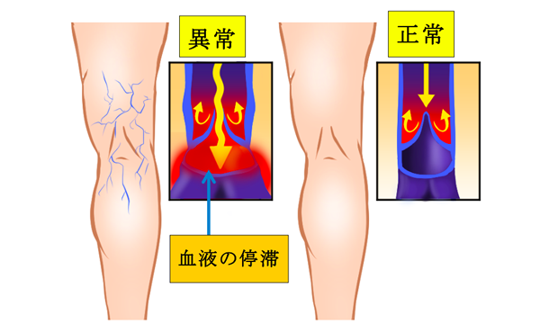 知ってください下肢静脈瘤のこと ｜ 下肢静脈瘤の治療法