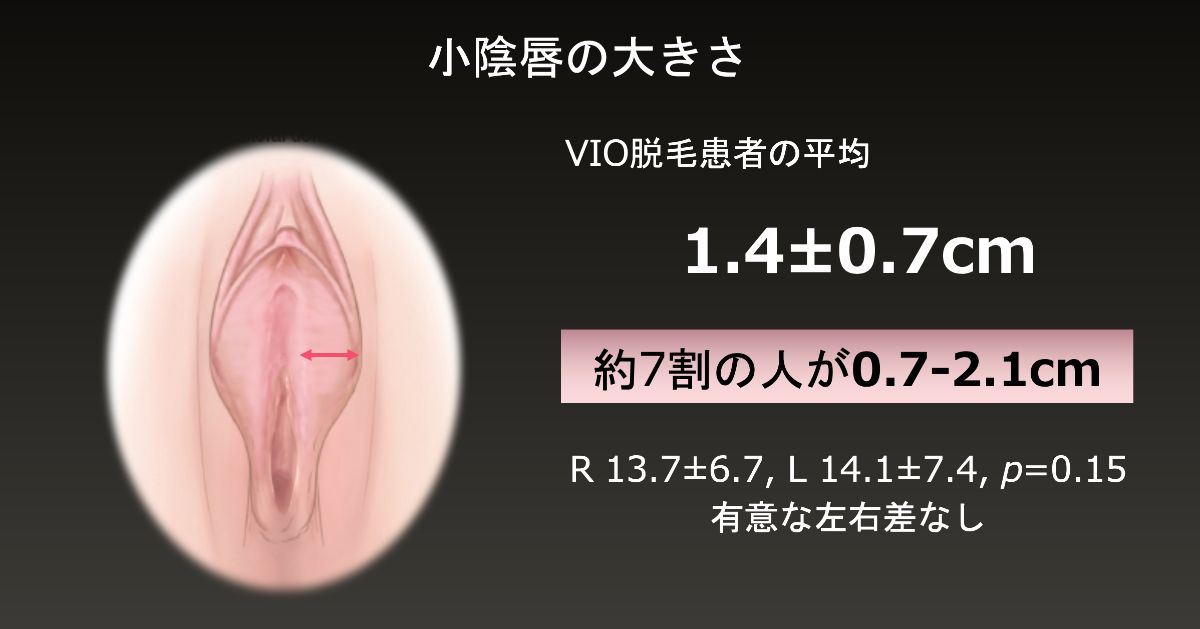 バルトリン腺嚢胞の原因・症状と効果的な治療法を女医が丁寧に解説。 –  港区、品川区の産婦人科で妊婦健診・産後ケア・避妊相談なら│海老根ウィメンズクリニック