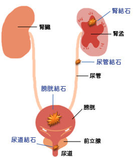 腎臓結石はセックスで治るってホント？: J-CAST ニュース【全文表示】