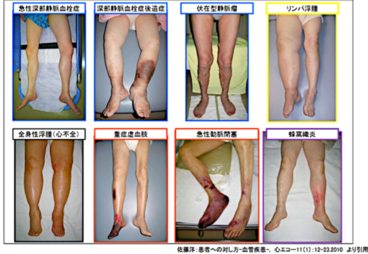 下肢静脈瘤の症状 - 医療法人社団康静会
