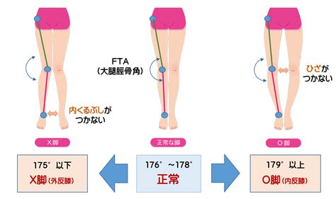 X脚の治し方｜専門家が語るX脚の実際