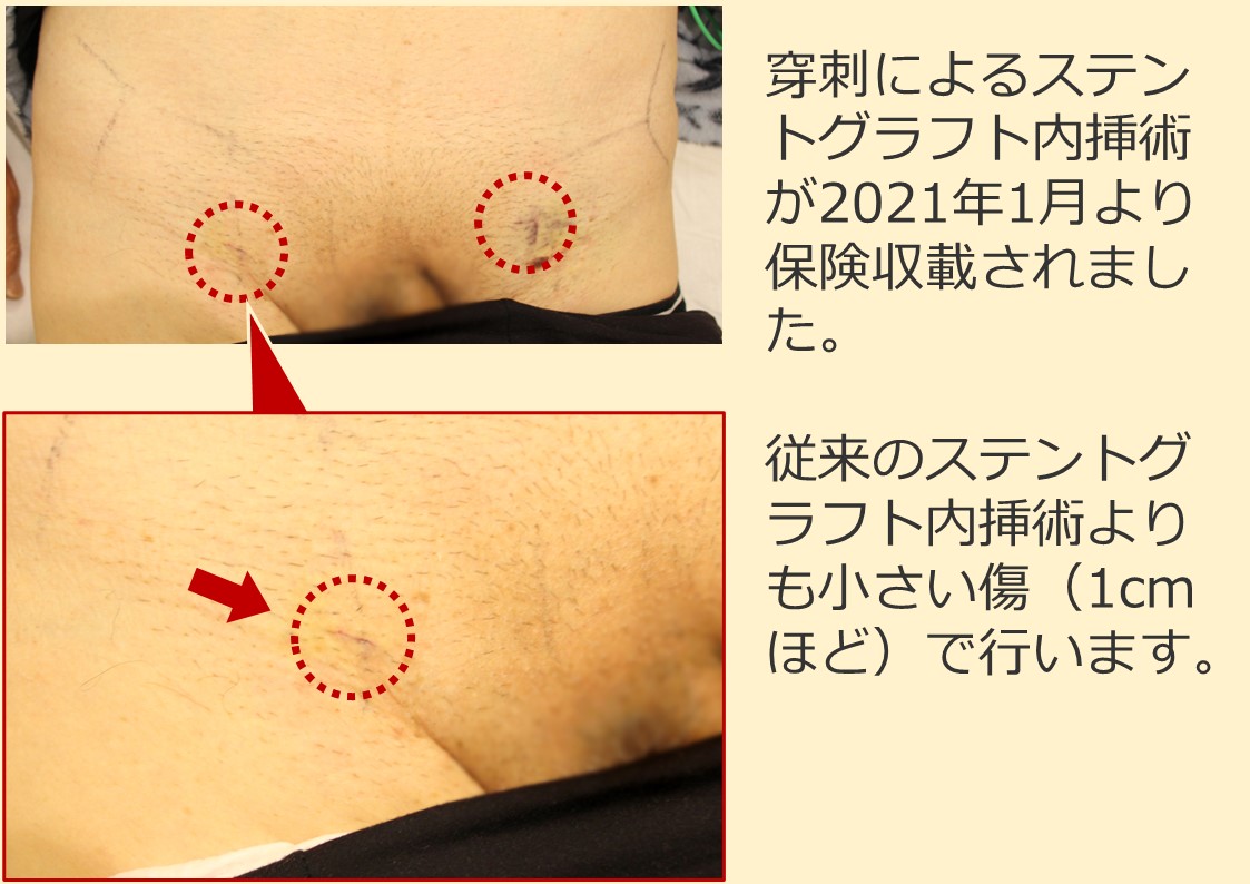 当院における鼠径部ヘルニア手術の取り組み ｜ 国立長寿医療研究センター